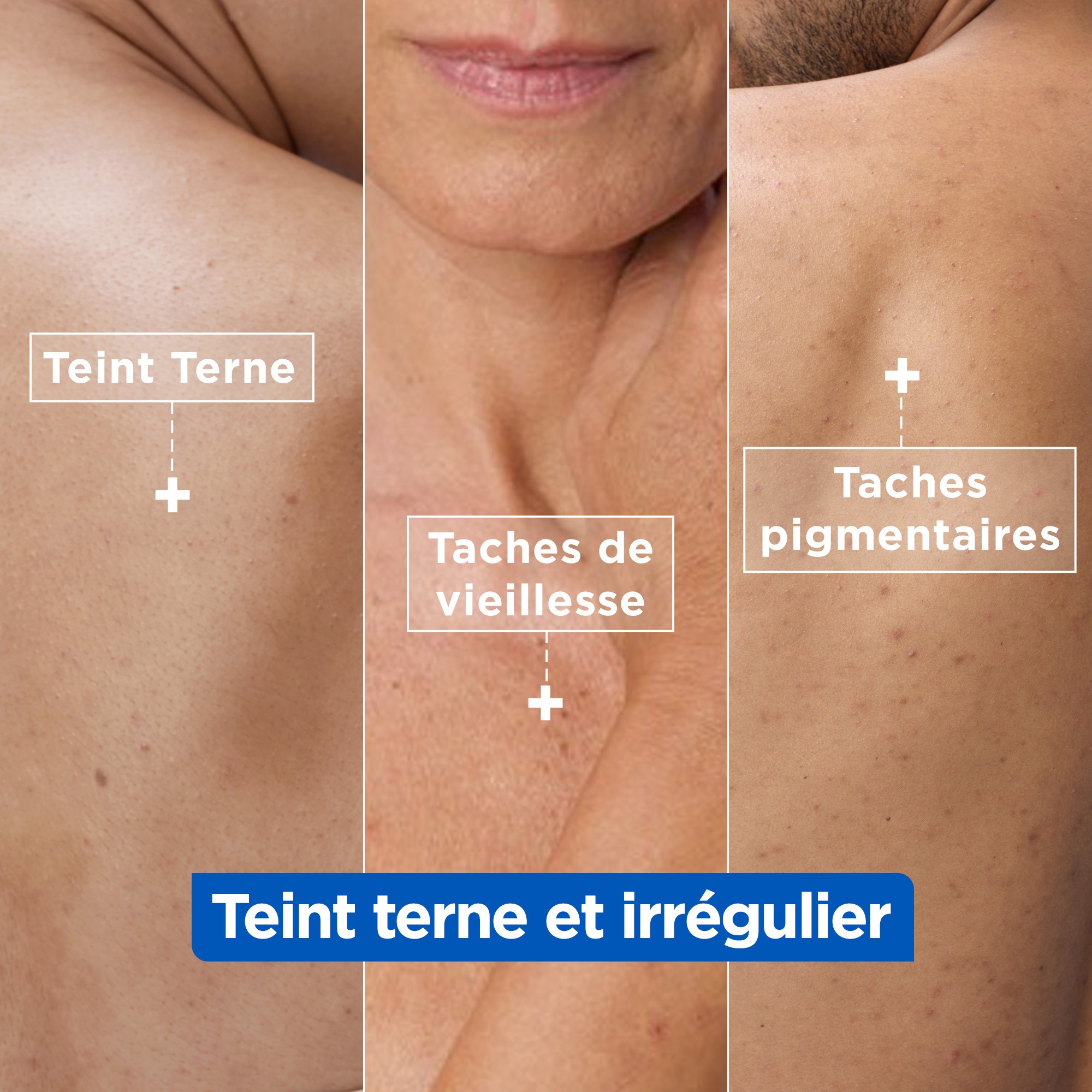 Mixa éclat Les taches pigmentaires peuvent être causées par l'exposition au soleil, le vieillissement cutané ou les imperfections.